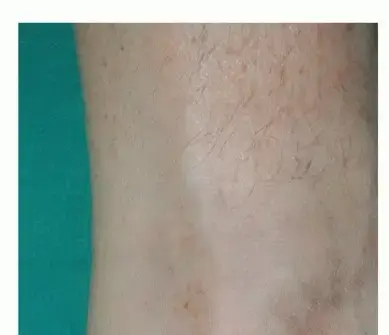 صورة توضيحية لـ التهاب وتر أخيل الإدخالي: دليلك الشامل لآلام الكعب الخلفي والعلاج الفعال مع الدكتور محمد هطيف