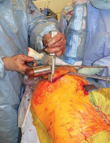 Illustration 58 for Exploring the Ambulatory Surgical Setting for Total Hip Replacement