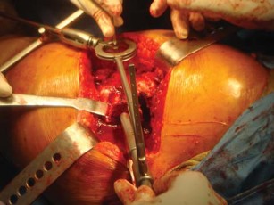 Illustration 30 for The Silent Hip: Achieving a Truly Silent, Pain-Free Joint