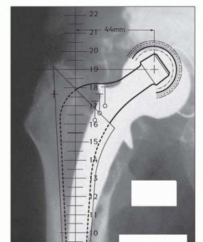 Illustration 5 for Exeter Hip Unit: Mastering Impaction Allografting for Femoral Bone Loss