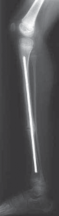 Illustration 24 for Solving Congenital Pseudarthrosis: Tibia with the Williams Rod