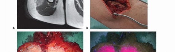 Illustration 12 for Targeted Ablation of Musculoskeletal Tumors: A Safer Approach