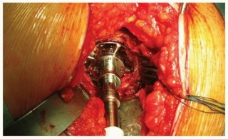 Illustration 2 for Cemented Acetabular Component: Achieving Optimal THA Stability