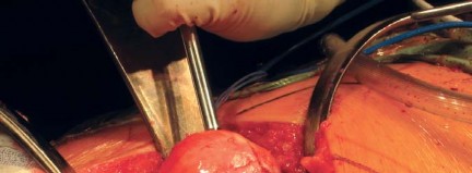 Illustration 44 for Metal on Metal Resurfacing: Enhanced Posterior Soft Tissue Repair