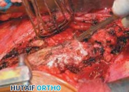 Illustration 40 for Mastering Anterior Interbody Arthrodesis with Instrumentation for Scoliosis