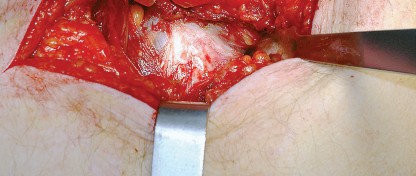 Illustration 23 for Unlock the Figure Posterior Approach to the Hip