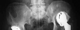 Tackling Paprosky Type IIIA: Acetabular Augment in Revision Hip