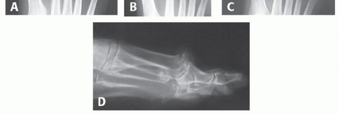 Illustration 8 for End Articular Cartilage Loss: Arthrosurface HemiCAP Resurfacing