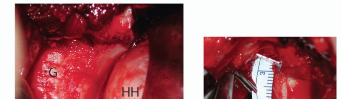 Illustration 17 for Glenoid Bone Graft for Anterior Shoulder Instability: Restore Stability