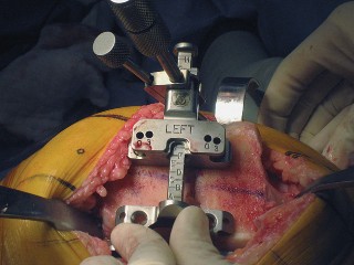 Illustration 27 for Posterior Stabilized Technique: Essential Insights for TKA Success