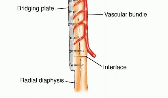 Illustration 40 for Free Vascularized Fibular Grafts: Solving Complex Bone Defects