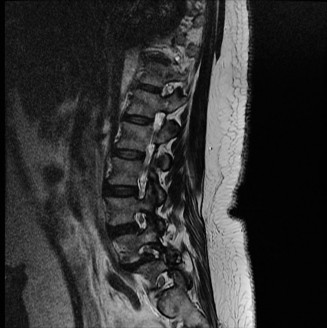 Illustration 5 for Spondylodiscitis: Deciphering the next course of action