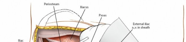Illustration 70 for Pelvis & Acetabulum Approaches: Unlocking the Posterior Superior Iliac