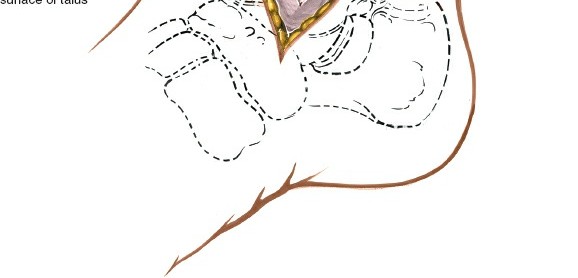 Illustration 21 for Optimized Approaches to the Dorsum of the Foot & Ankle