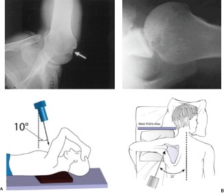 Illustration 2 for Elbow & Shoulder Cases: Spotting Critical Hill-Sachs Lesions