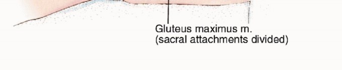 Illustration 14 for Anterior Flap Hemipelvectomy: Leveraging fig tech fig for Difficult Tumors