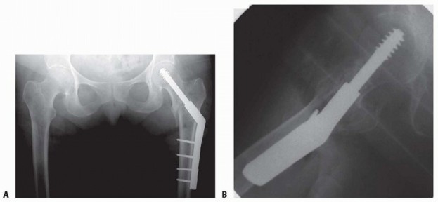 Illustration 23 for ORIF for Peritrochanteric Hip Fractures: Achieve Stable Mobility