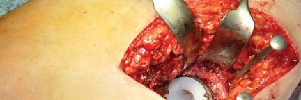 Illustration 23 for Collum Femoris Preserving: Achieve Better Primary Hip Outcomes