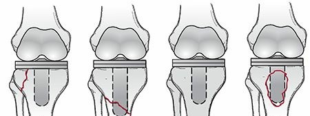 Illustration 8 for Periprosthetic Fractures: Causes, Risks, & Effective Treatment