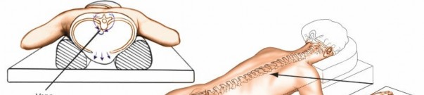Illustration of spine posterior approach - Dr. Mohammed Hutaif