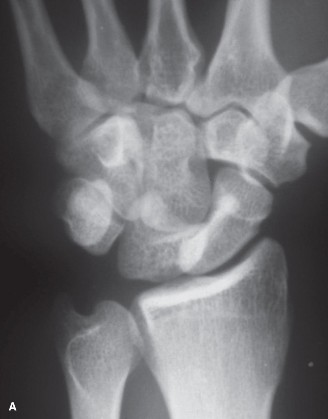 Illustration 5 for Christine M Kleinert Discussion: Solving Difficult Wrist Fractures