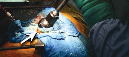 Illustration 101 for Birmingham Hip Resurfacing Designer's Technique for Active Lives