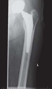 Illustration 66 for Kinectiv® Stem: Modular Necks for Primary THA Success