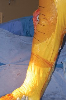 Illustration 50 for Mastering Gap Balancing in Revision TKA: Avoid Common Pitfalls