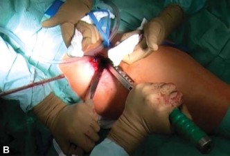 Illustration 14 for Mastering the Anterolateral Approach in Minimally Invasive Hip Replacement