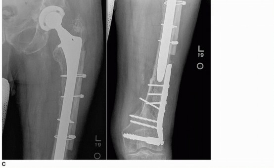 Illustration 19 for Mastering Revision THA: Strategies for Adverse Local Tissue Challenges