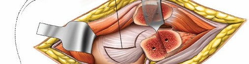 Illustration 133 for Pelvis & Acetabulum Approaches: Unlocking the Posterior Superior Iliac