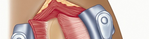 Illustration 24 for Mastering the Treatment of Recurrent Posterior Shoulder Instability