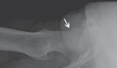 Illustration 43 for Resolving Femoral Head Neck Impingement: Arthroscopic FAI Solutions