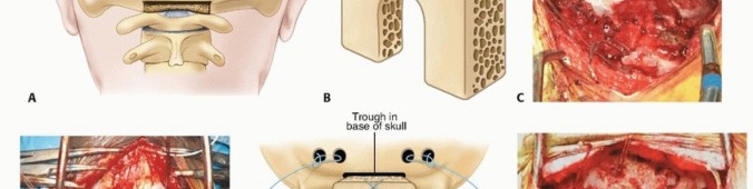 Illustration 23 for Addressing Cervical Spine Instability with Posterior Arthrodesis