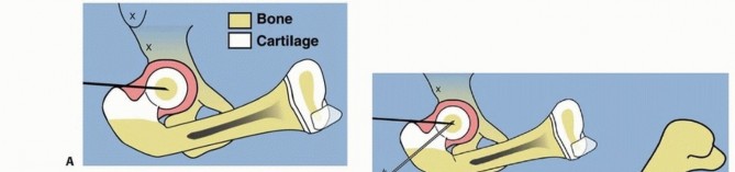 Illustration 21 for Treatment for Congenital Femoral Deficiency: What You Need to Know