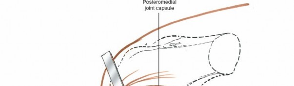 Illustration 78 for Mastering Knee Approaches: Spotlight on Superficial Medial Ligament