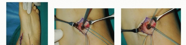Illustration 18 for Foot Drop Surgery: How a Pin or Drill Elevates Tendon Transfer