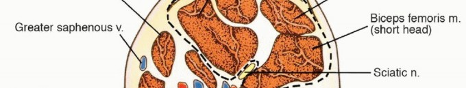 Illustration 2 for Posterior Thigh Resection: Rethinking Outcomes & Limb Sparing