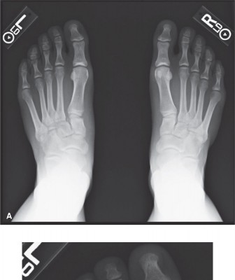 Missed Lisfranc? Focus on the Base of the Second Metatarsal
