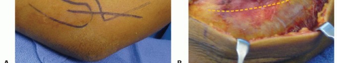Illustration 28 for Radial Head & Neck Fractures: Mastering ORIF for Best Results