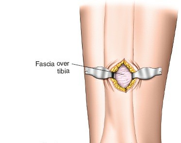 Illustration 66 for Surgical Access: Mastering the Tibia's Surface & Fibula Approaches