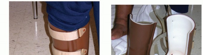 Regain Mobility: Surgical Solutions for Charcot Foot Arthropathy