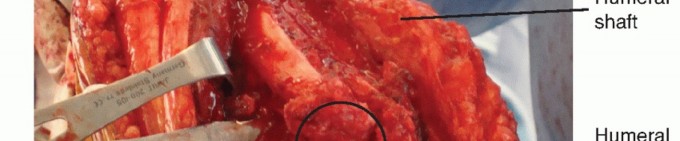 Illustration 17 for Surgical Approaches to Shoulder & Elbow: Pearls and Pitfalls