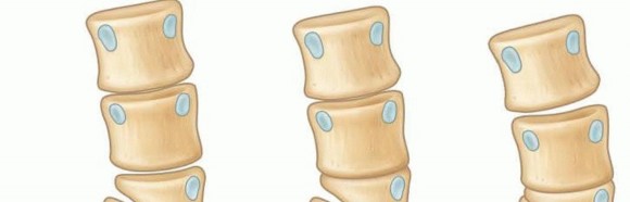 Hemivertebra Excision: Understanding This Key Surgery for Hemivertebra