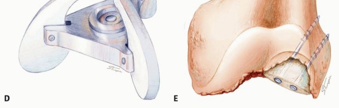 Illustration 7 for Optimizing Revision Femoral Component with Distal Femoral Bone Loss