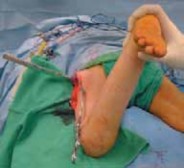 Illustration 32 for Increased Femoral Anteversion: A Proximal Femoral Rotational Osteotomy