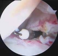 Illustration 27 for Capsular Releases for Loss of Motion: Restore Your Shoulder