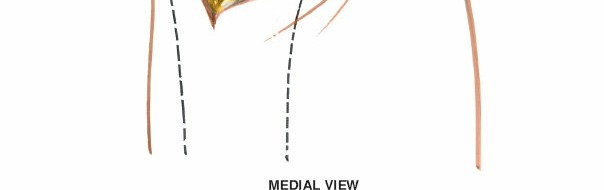 Illustration 69 for Mastering Knee Approaches: Spotlight on Superficial Medial Ligament