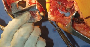 Illustration 33 for Mastering Gap Balancing in Revision TKA: Avoid Common Pitfalls