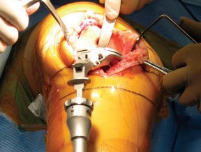 Illustration 11 for Minimally Invasive Subvastus: The Best Path to Quicker TKA Recovery